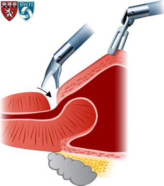 The Impact of Prostate Size, Median Lobe, and Prior Benign Prostatic ...