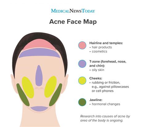 Acne face map: Causes of breakouts