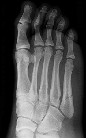 Some questions about 5th Metatarsal Fracture : r/brokenbones