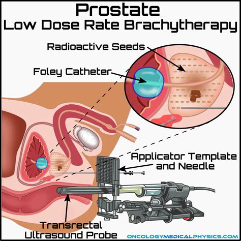 Prostate Brachytherapy | Oncology Medical Physics