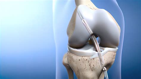 After ACL Reconstruction: Complication and post-surgery treatment ...