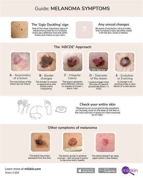 Melanoma Symptoms and Signs: Extensive Guide