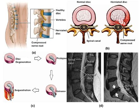 Lumbar Disc Herniation (a) Showing herniated disc at L4/L5 level [14 ...