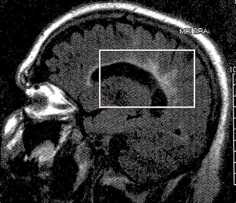 neuropathology blog: Dawson Fingers: A Cocktail-Party Term Worth Knowing