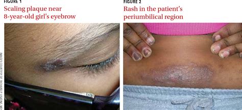 Figure 1 from Rash on eyebrows and periumbilical region. | Semantic Scholar