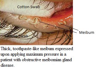 Meibomian Gland Expression Tool