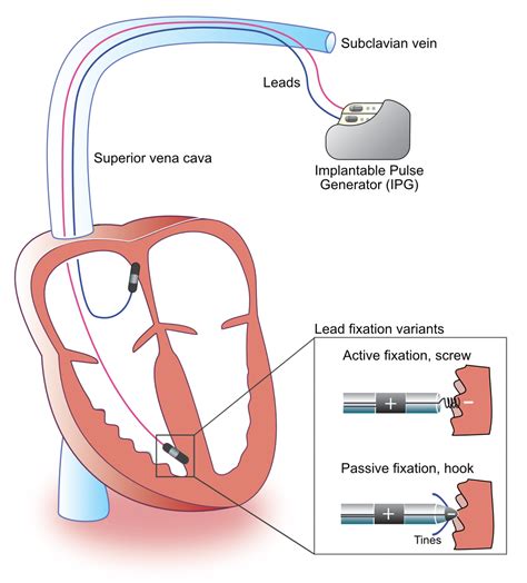 Artificial Heart Circuit Diagram