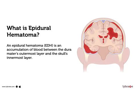 Epidural Hematoma: Causes, Symptoms, Treatment and Cost