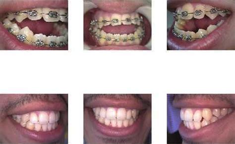 Treatment options for anterior open bite