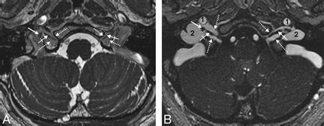 Jugular Foramen Mri