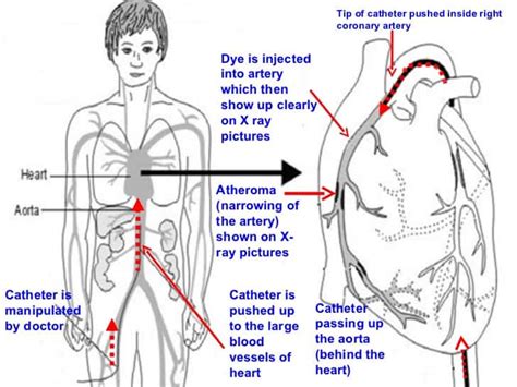 About Coronary Angiography Test Procedure, Dos and Donts