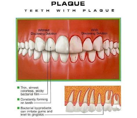 How to Get Rid of Plaque?