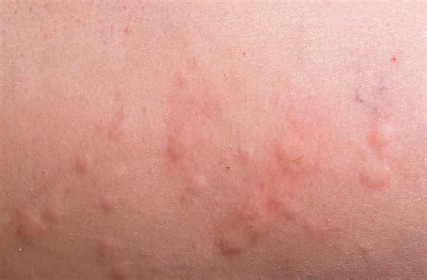 What is Aquagenic Urticaria? (with pictures)