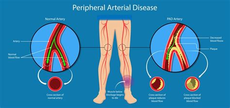 Peripheral Arterial Disease Treatment in Denver, CO | MIPS Center