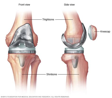 Knee replacement surgery - Mayo Clinic