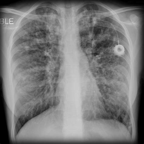 Cystic Fibrosis - USMLE Strike