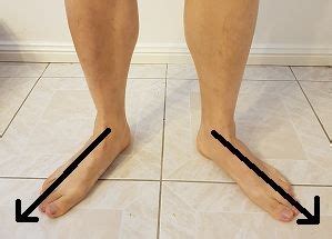 How to fix Duck feet posture | Duck feet, Postures, Foot exercises