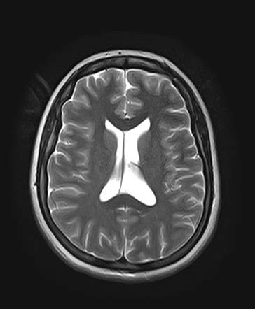 Schizophrenia Brain Ventricles