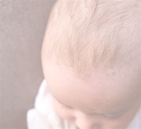 Cradle Cap On Your Baby's Face: Causes And Treatment