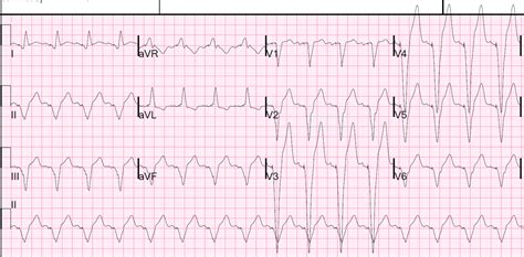 Dr. Smith's ECG Blog: Massive Excessively Discordant Anterior ST ...