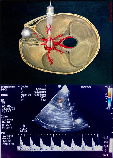 Frontiers | Transcranial Doppler during the first week after cardiac ...