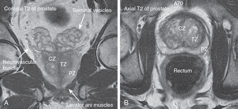 cama Persona a cargo del juego deportivo cama prostate mri anatomy ...