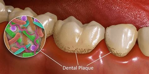 How to Get Rid of Plaque (the effective way)