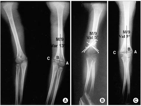 Cubitus Valgus And Cubitus Varus