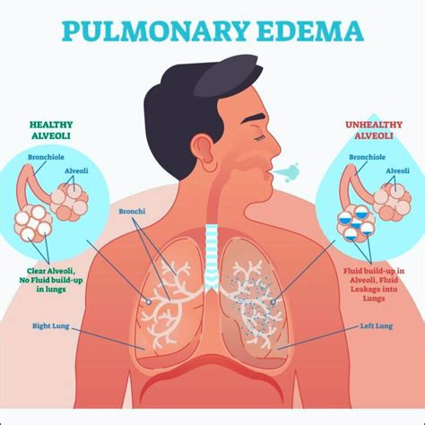 Pulmonary edema: Causes, Risk Factors, Symptoms, Treatment