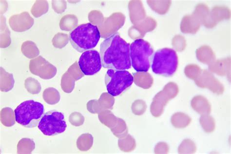 Podcast: Early Detection of Acute Myeloid Leukemia (AML) | Patient Care