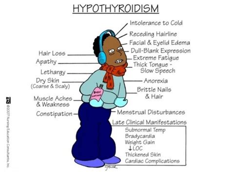 Myxedema coma