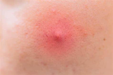 Armpit pimple: Types, causes, and treatments