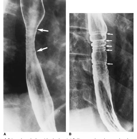 Table 1 from Congenital esophageal stenosis in adults | Semantic Scholar