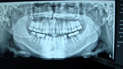 Mandibular Fracture X Ray