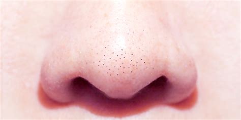 Blackheads On Nose: Removal Treatments, Cost And Results