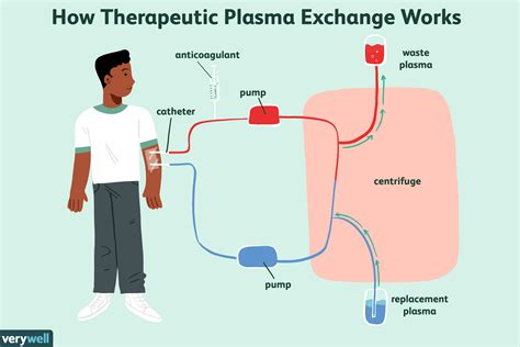 ¿Qué es el intercambio de plasma terapéutico (TPE)? - Medicina Básica