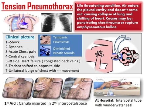 Pin on Nursing: Respiratory