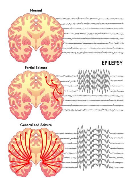 Can Essential Oils Help With Seizures And Epilepsy | Essential Oil Benefits