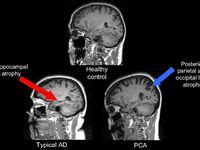 Posterior Cortical Atrophy