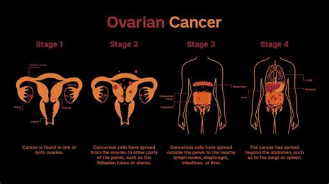 Treatment of Invasive Epithelial Ovarian Cancers by Stage - YouTube