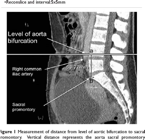 Figure 1 from Measurement of aorta sacral promontory distance in ...