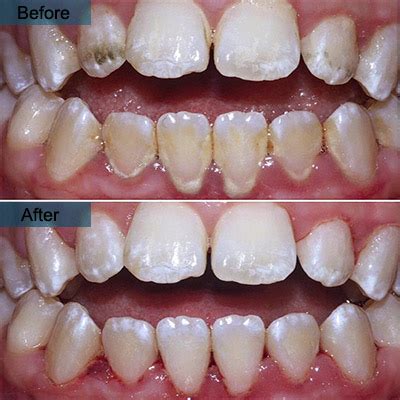 Whats The Average Cost Of Deep Cleaning Teeth - Teeth Poster