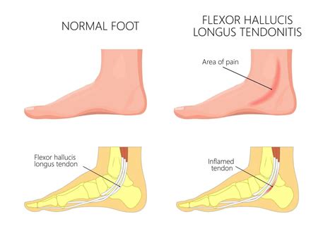 Flexor Hallucis Longus | Flexor Hallucis Longus Tendonitis