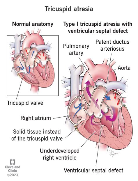 Tricuspid Atresia: Causes, Symptoms and Treatment