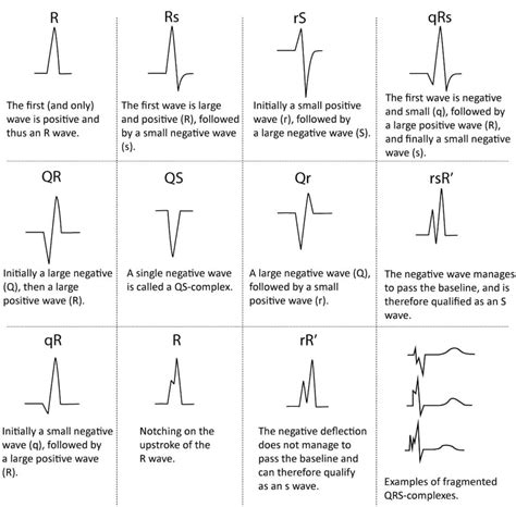 qrs complex,various configuration