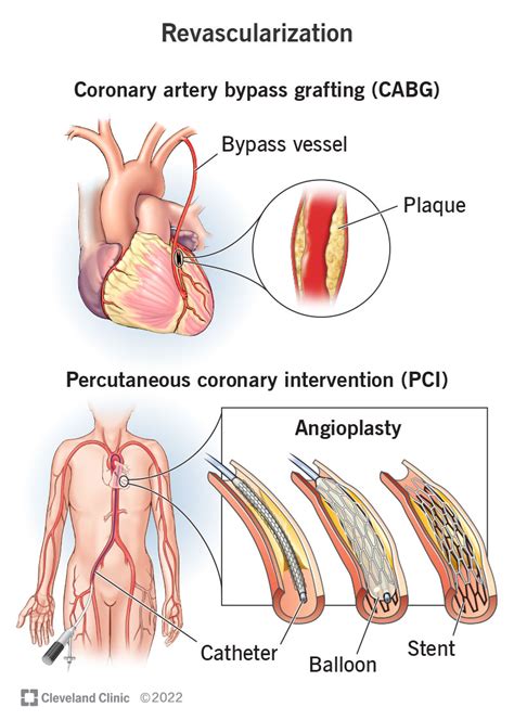 Opening all arteries best when heart attack strikes in old age: Study