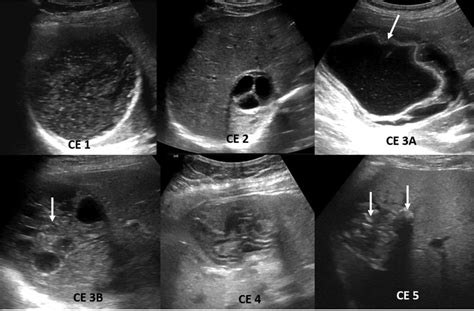 Hydatid cyst: Ultrasound. Multiple stages of hydatid cyst are shown ...