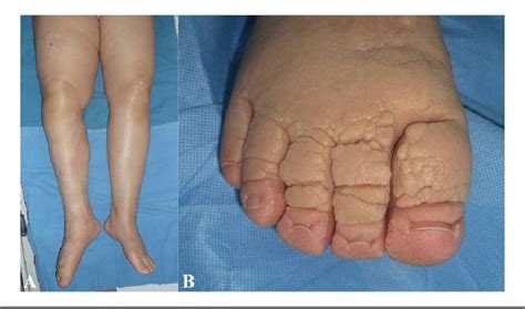 Successful Surgical Treatment for Elephantiasis Nostras Verrucosa Using ...