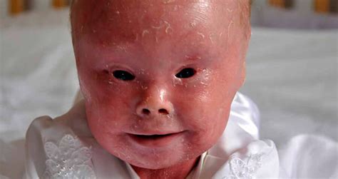 Harlequin Ichthyosis: Photos And Stories Of The Rare Skin Disease