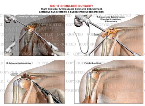 Right shoulder arthroscopic debridement - Synovectomy - Subacromial ...